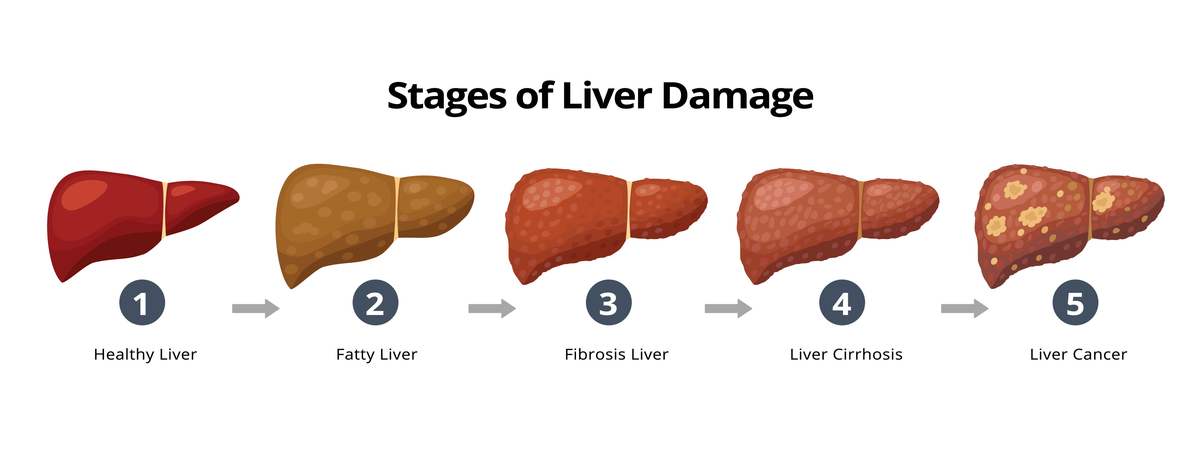 The Silymarin Advantage In Chronic Liver Disease